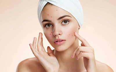 Como prevenir a acne?