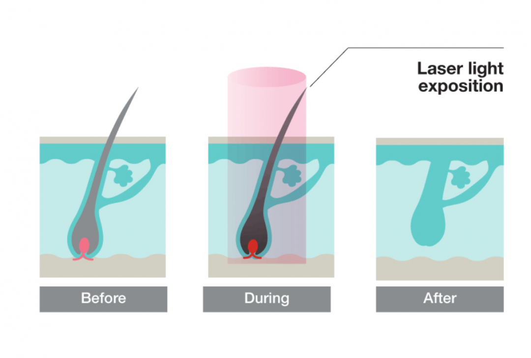 The Comparison of Diode Laser Hair Removal and IPL.dimyth