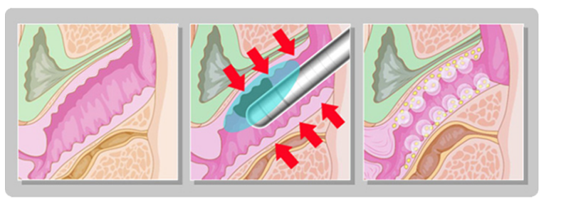 HIFU Rejuvenescimento Vaginal